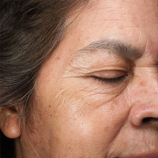 Idős hölgy lézeres szemhéj kezelés előtte utána kép