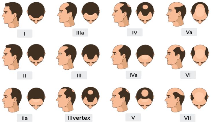 Hamilton-Norwood hajhullás skála, forrás: https://www.smilehairclinic.com/en/the-norwood-hamilton-scale/