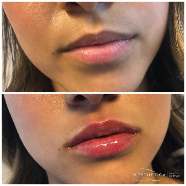 hialuronsavas ajakfelöltés előtte utána kép