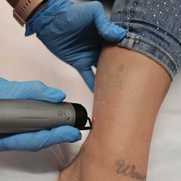 Tetoválás eltávolítás a lábszáron