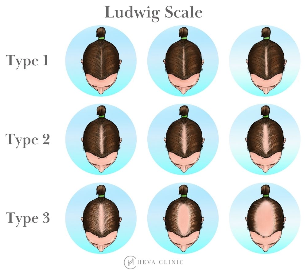 Ludwig hajhullás skála, forrás: https://www.dentalhairclinicturkey.com/blog/female-pattern-baldness-solutions-ludwig-scale/